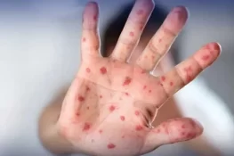 خیبر پختونخوا میں خسرے کے کیسز میں اضافہ ریکارڈ