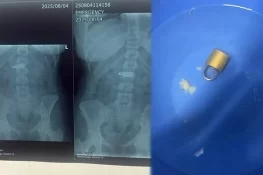 23 سالہ خاتون کے پیٹ سے بغیر آپریشن کے تالا نکال لیا گیا، مگر کیسے؟