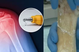 سائنسدانوں نے 3 منٹ میں ہڈی جوڑنے والا "جادوئی گلو” تیار کرلیا