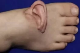 چینی خاتون کے کان کی نایاب سرجری: کان کو پہلے پیر پر لگانے کی وجہ سامنے آگئی